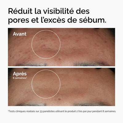 The Ordinary Niacinamide 10% + Zinc 1% - Sérum Anti - Imperfections 30ml - Home Chic Choc30 ml (Lot de 1)